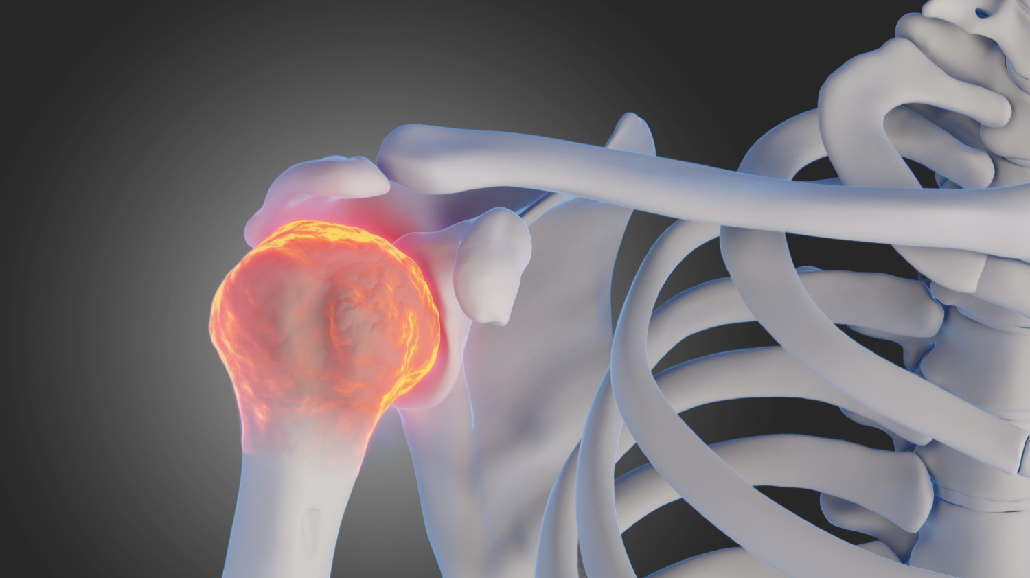 plantar faciitis illustration