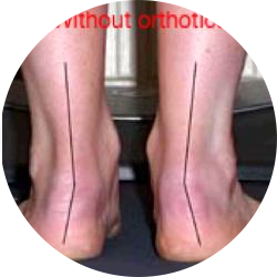 orthotic illustration without orthotics round